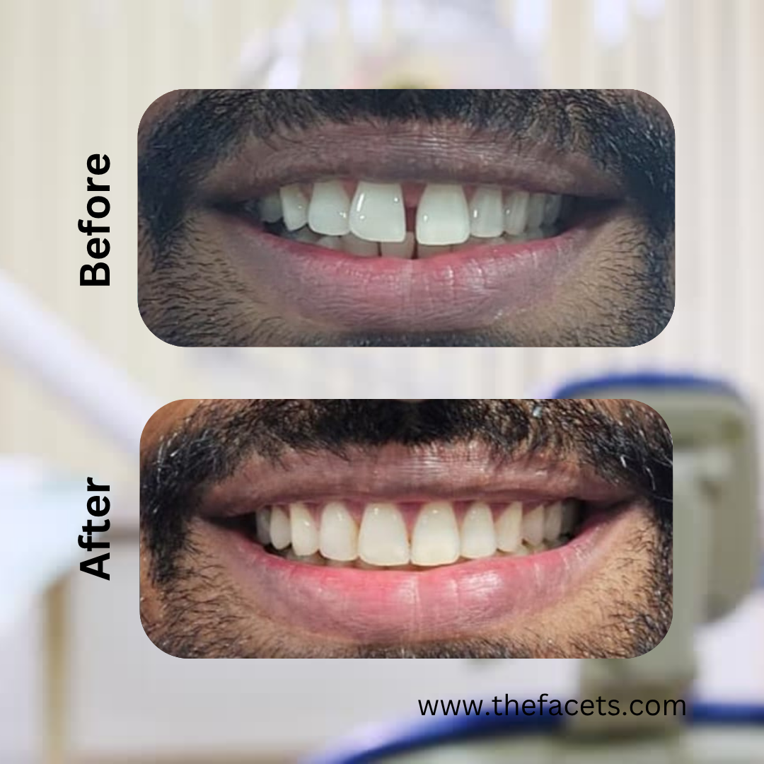 Before After Result 4